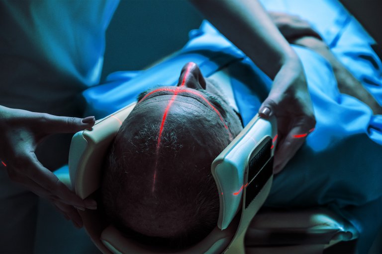 A person lying down with their head secured in a medical device, featuring red laser lines projected across their scalp, likely for precise imaging or treatment. The individual is covered with a blue medical drape, and a healthcare professional is adjusting the device around the person's head. The setting appears clinical, with a focus on the head and laser alignment.